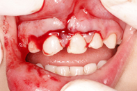 Οδοντικό τραύμα