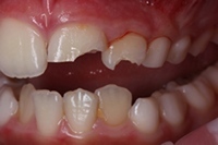 Οδοντικό τραύμα με αποκάλυψη πολφού